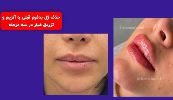 عکس تزریق ژل لب نیم سی سی