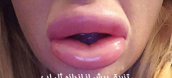 عکس تزریق ژل لب طبیعی
