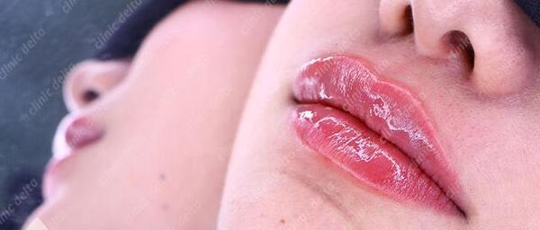 عکس تزریق ژل لب طبیعی