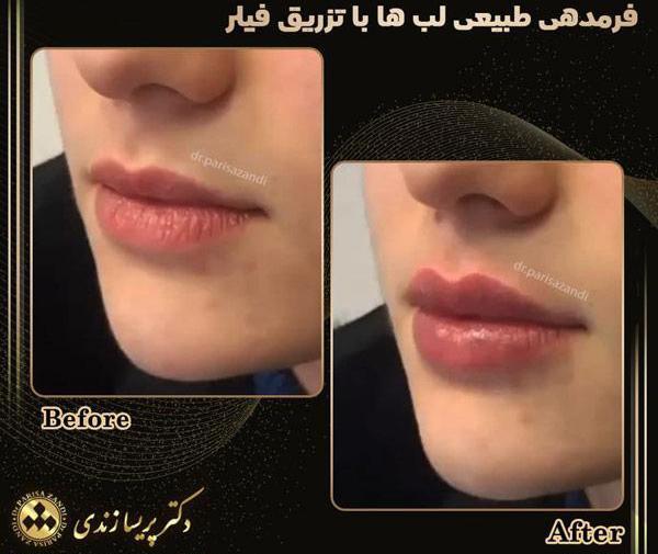 عکس تزریق ژل لب طبیعی