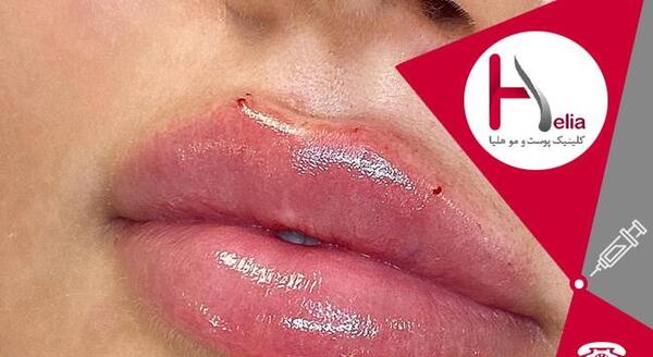 عکس تزریق ژل لب طبیعی