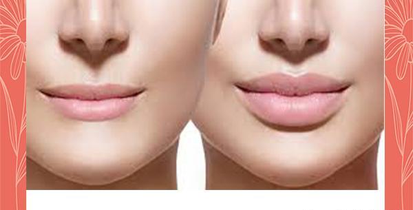 عکس تزریق ژل لب طبیعی