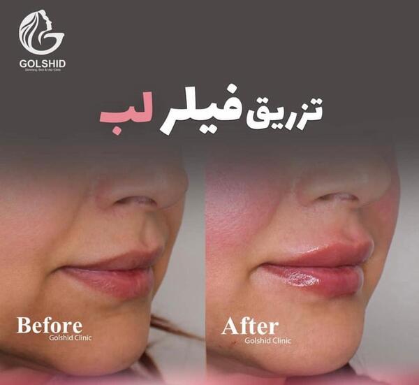 عکس تزریق ژل لب طبیعی