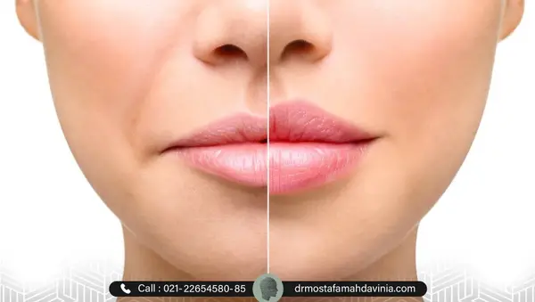 عکس تزریق ژل لب طبیعی