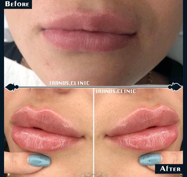 عکس تزریق ژل لب طبیعی