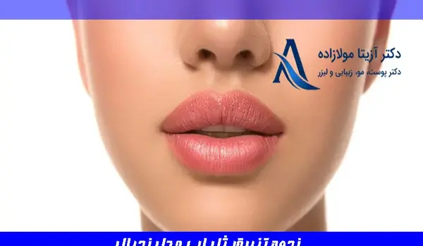 عکس تزریق ژل لب طبیعی