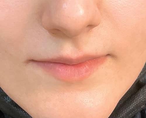 عکس تزریق ژل لب طبیعی