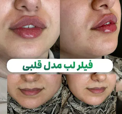 عکس تزریق ژل لب طبیعی