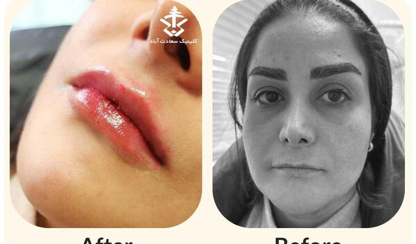 عکس تزریق ژل لب قبل و بعد