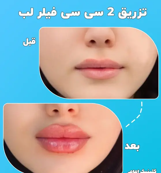 عکس تزریق ژل لب قبل و بعد