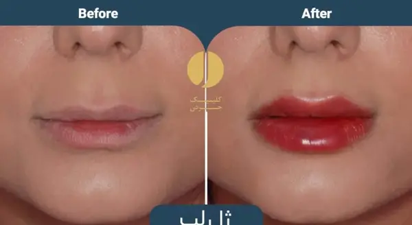 عکس تزریق ژل لب قبل و بعد
