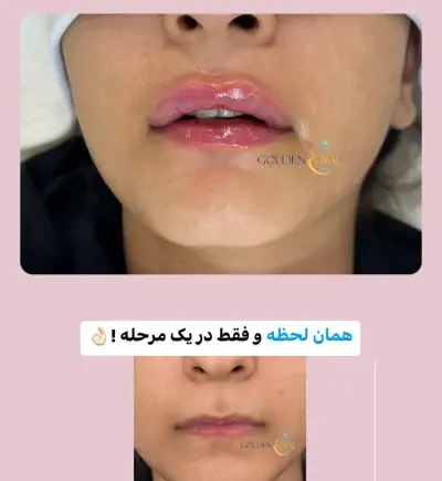 عکس تزریق ژل لب قبل و بعد