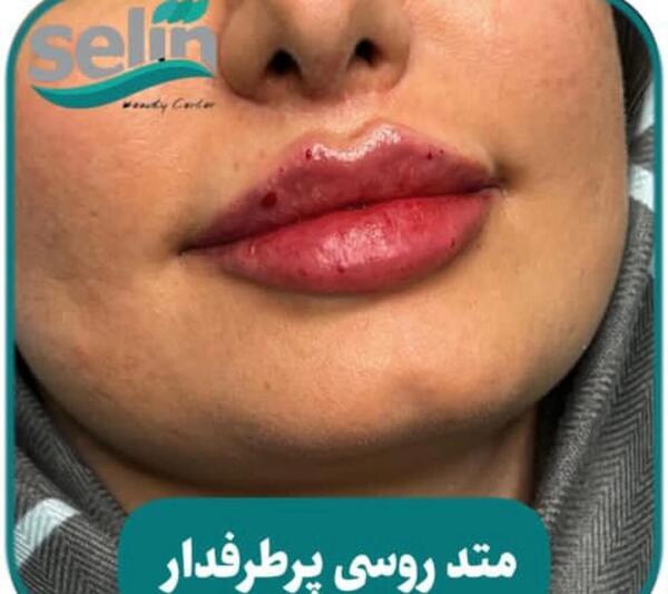 عکس تزریق ژل لب قبل و بعد