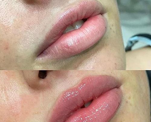 عکس تزریق ژل لب قبل و بعد
