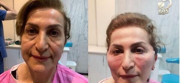 عکس تزریق ژل لب قبل و بعد