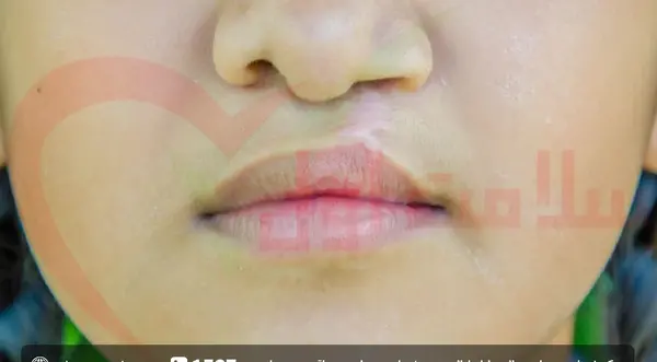عکس لب شکری دختر