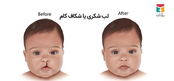 عکس لب شکری ها
