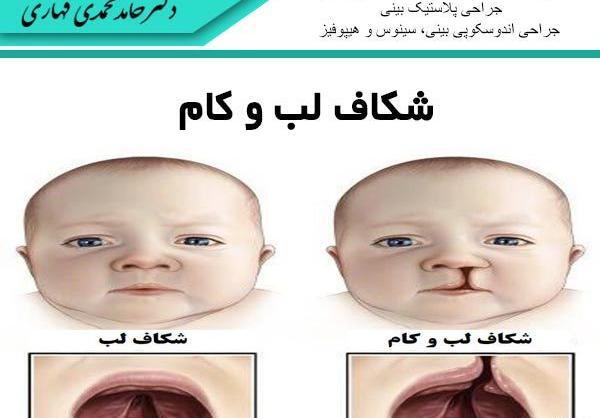 عکس لب شکری قبل از عمل