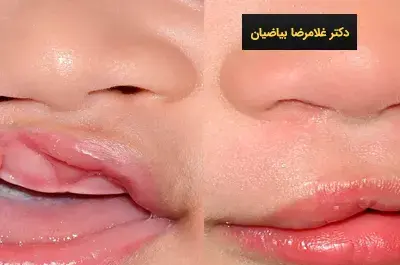عکس لب شکری قبل از عمل