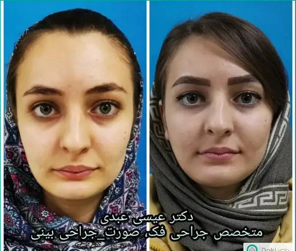 عکس لب شکری قبل از عمل