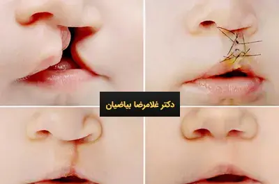 عکس لب شکری قبل از عمل