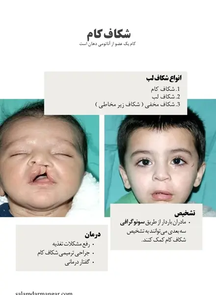 عکس لب شکری قبل از عمل