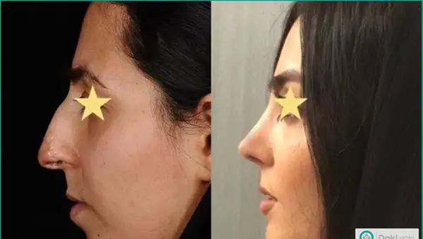 عکس لب شکری قبل از عمل