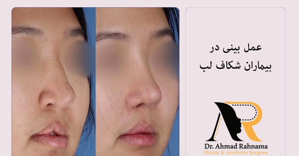 عکس لب شکری قبل از عمل