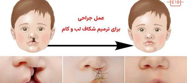 عکس لب شکری قبل از عمل