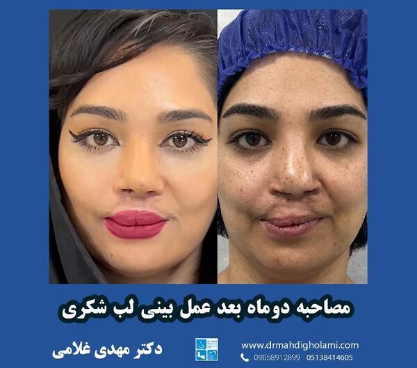 عکس لب شکری قبل از عمل