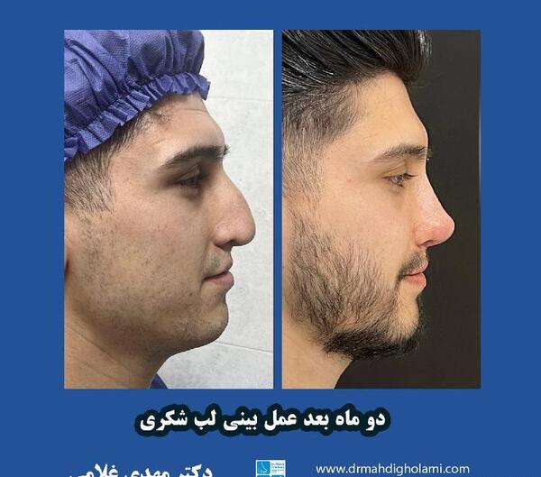 عکس لب شکری قبل از عمل