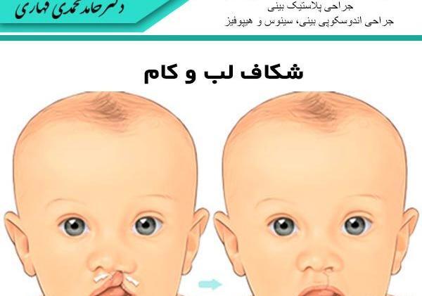 عکس لب شکری قبل از عمل