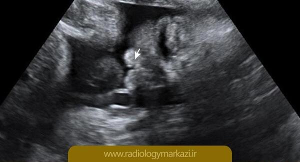 عکس لب شکری در سونوگرافی