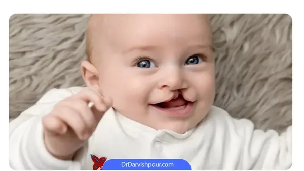 عکس نوزادان لب شکری