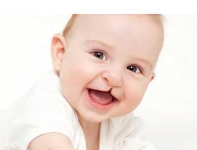 عکس نوزادان لب شکری