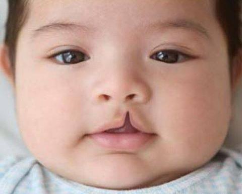 عکس نوزادان لب شکری