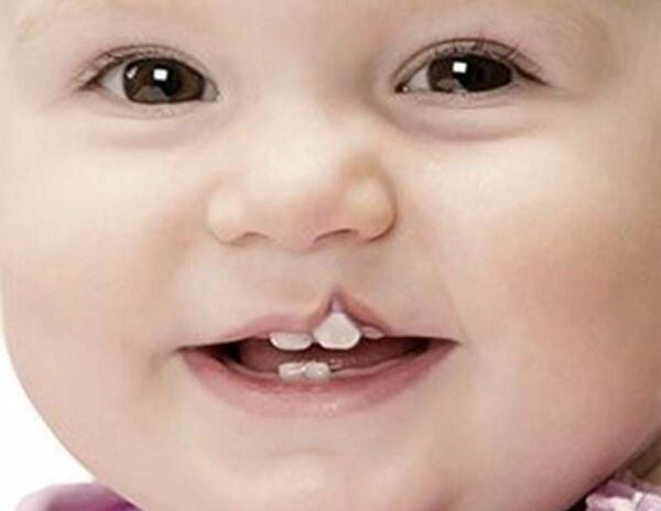 عکس از نوزادان لب شکری