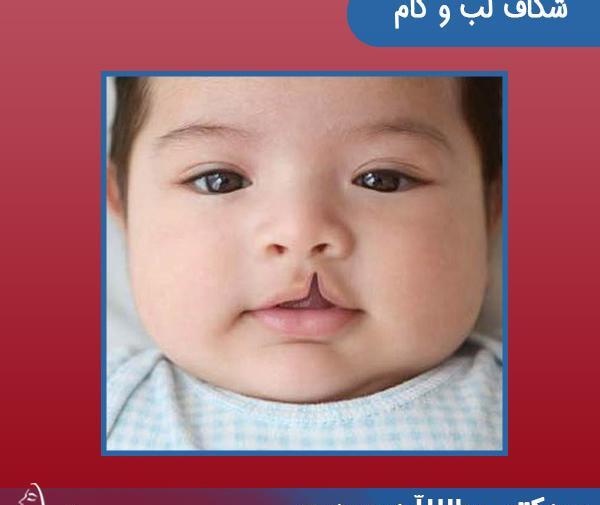 عکس از نوزادان لب شکری