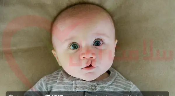 عکس از نوزادان لب شکری