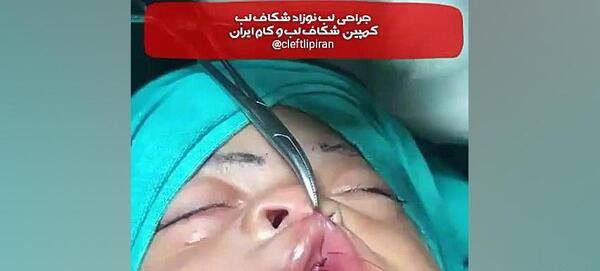عکس از نوزادان لب شکری