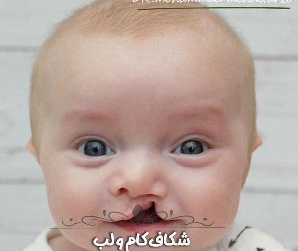 عکس از نوزادان لب شکری