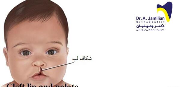 عکس از نوزادان لب شکری