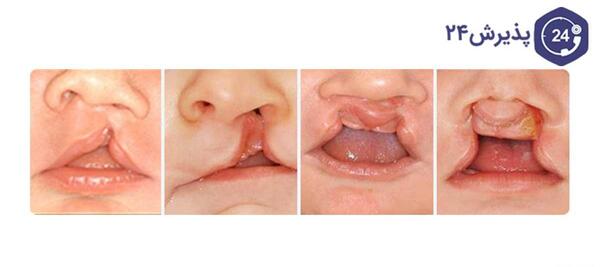 عکس از نوزادان لب شکری