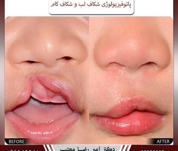 عکس از نوزادان لب شکری