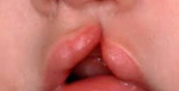 عکس از نوزادان لب شکری