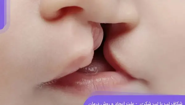 عکس از نوزادان لب شکری
