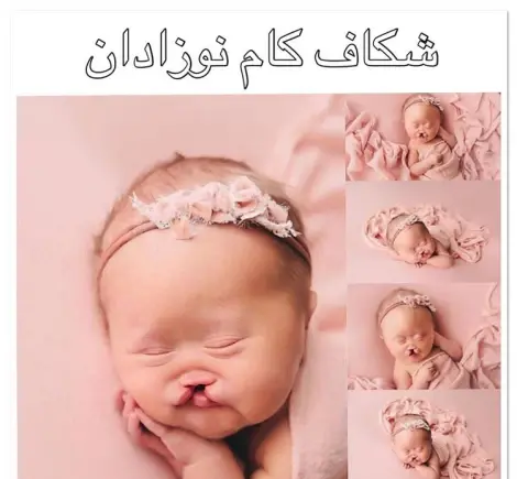 عکس بچه های لب شکری