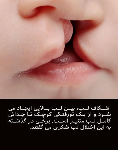 عکس بچه های لب شکری