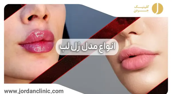 عکس ژل لب عروسکی