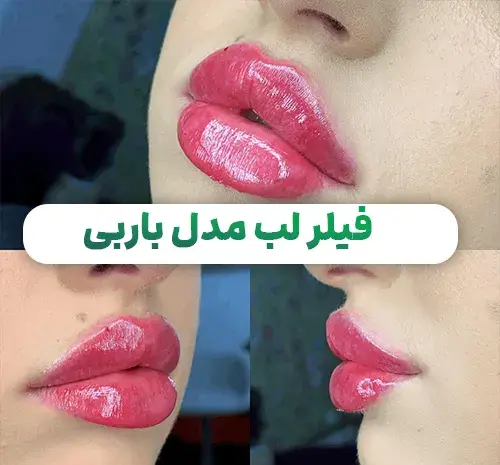عکس ژل لب عروسکی